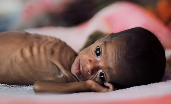 malnutrition